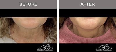 Dysport or Botox Before & After Gallery - Patient 463231 - Image 3