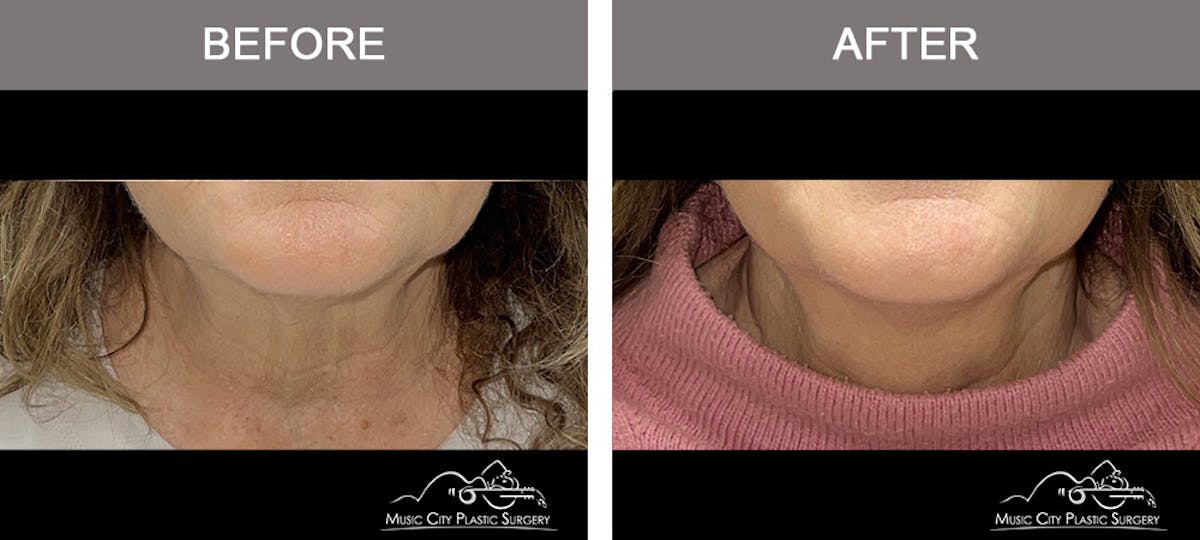 Dysport or Botox Before & After Gallery - Patient 463231 - Image 3