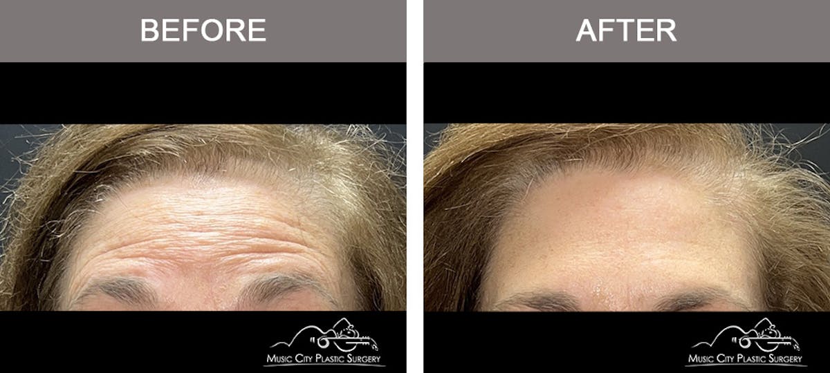 Dysport or Botox Before & After Gallery - Patient 463231 - Image 4