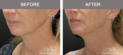 Dysport or Botox Before & After Gallery - Patient 247214 - Image 1