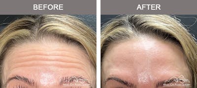 Dysport or Botox Before & After Gallery - Patient 204794 - Image 1