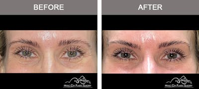 Dysport or Botox Before & After Gallery - Patient 204794 - Image 2