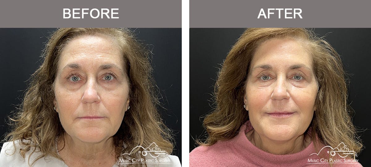 Dermal Fillers Before & After Gallery - Patient 127242 - Image 1