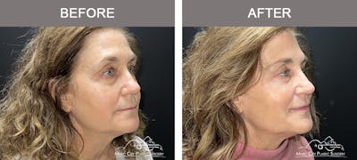 Dermal Fillers Before & After Gallery - Patient 127242 - Image 2