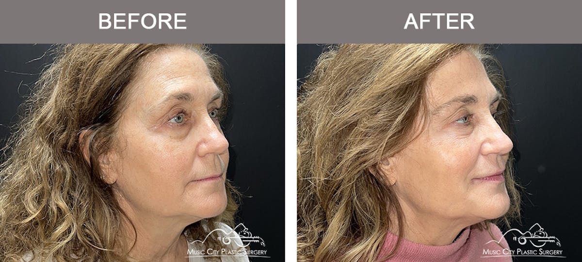 Dermal Fillers Before & After Gallery - Patient 127242 - Image 2