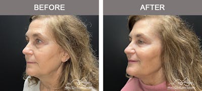Dermal Fillers Before & After Gallery - Patient 127242 - Image 3