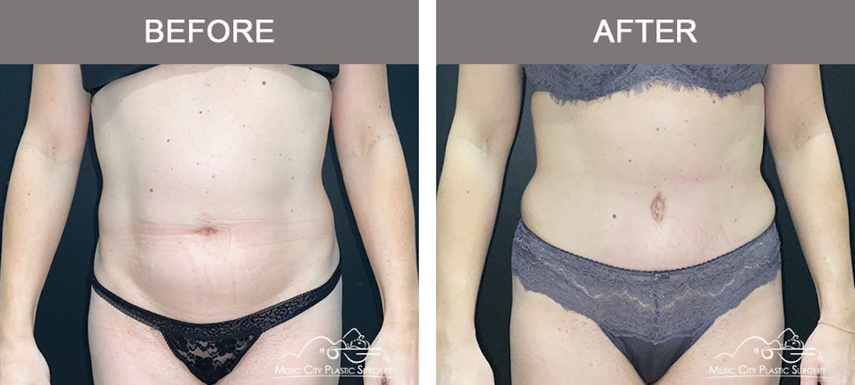 Abdominoplasty Before & After Gallery - Patient 873755 - Image 1