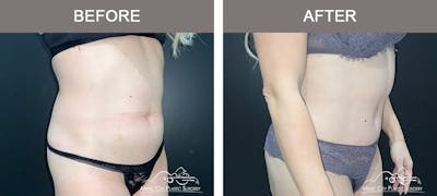 Liposuction Before & After Gallery - Patient 257519 - Image 2
