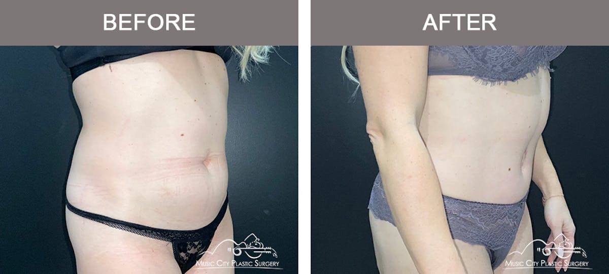 Abdominoplasty Before & After Gallery - Patient 873755 - Image 2