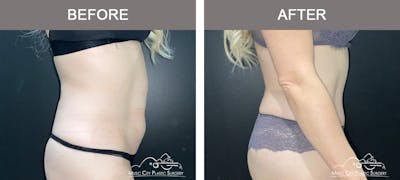 Abdominoplasty Before & After Gallery - Patient 873755 - Image 3