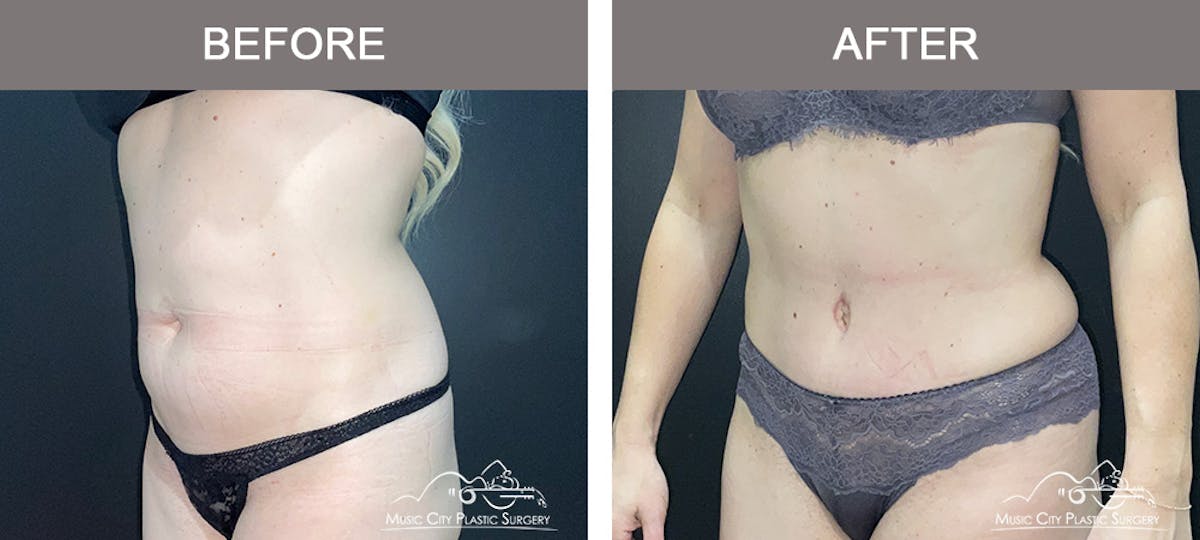 Abdominoplasty Before & After Gallery - Patient 873755 - Image 4