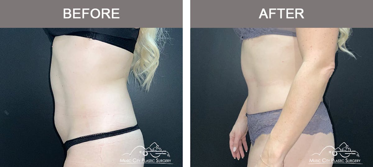Abdominoplasty Before & After Gallery - Patient 873755 - Image 5