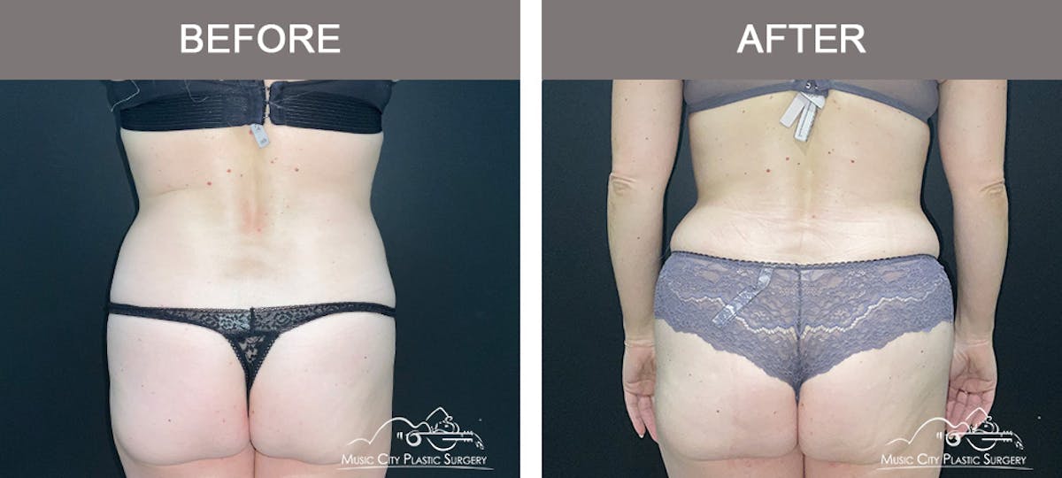 Abdominoplasty Before & After Gallery - Patient 873755 - Image 6
