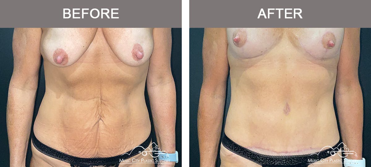 Abdominoplasty Before & After Gallery - Patient 571699 - Image 1