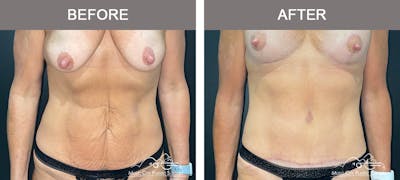 Abdominoplasty Before & After Gallery - Patient 571699 - Image 1