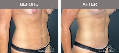 Abdominoplasty Before & After Gallery - Patient 571699 - Image 2