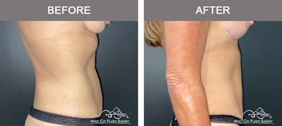 Abdominoplasty Before & After Gallery - Patient 571699 - Image 3