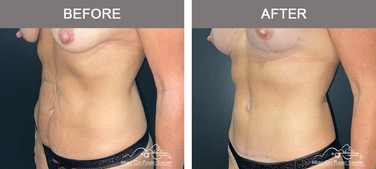 Abdominoplasty Before & After Gallery - Patient 571699 - Image 4
