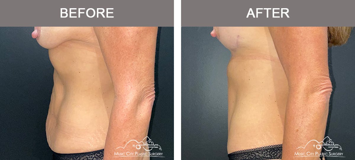 Abdominoplasty Before & After Gallery - Patient 571699 - Image 5