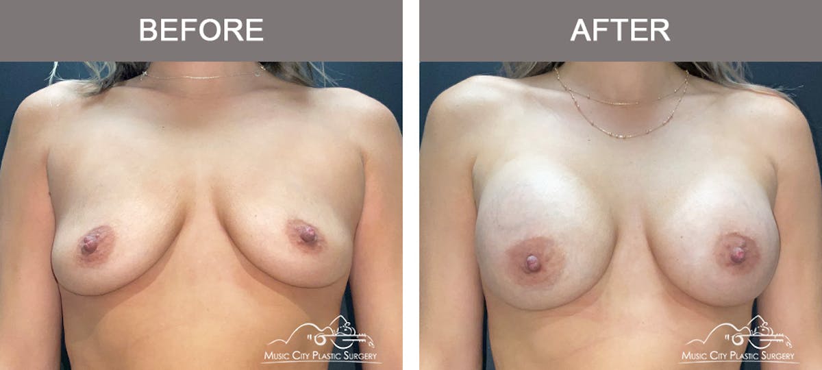 Breast Augmentation Before & After Gallery - Patient 421301 - Image 1