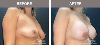 Breast Augmentation Before & After Gallery - Patient 421301 - Image 2