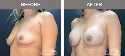 Breast Augmentation Before & After Gallery - Patient 421301 - Image 3