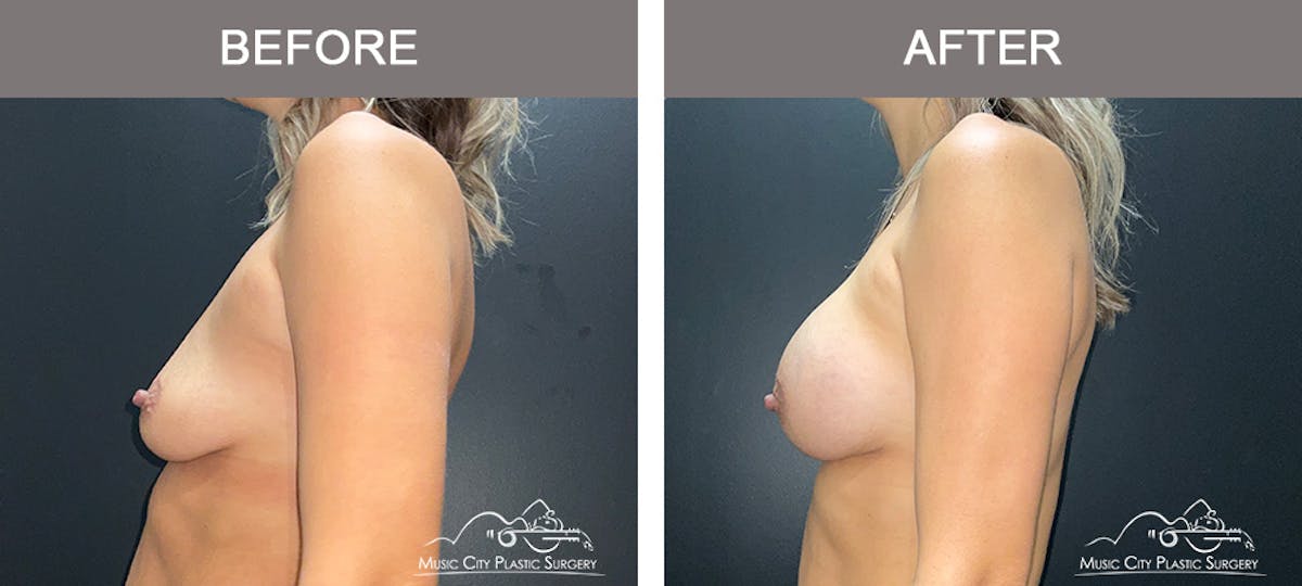 Breast Augmentation Before & After Gallery - Patient 421301 - Image 4