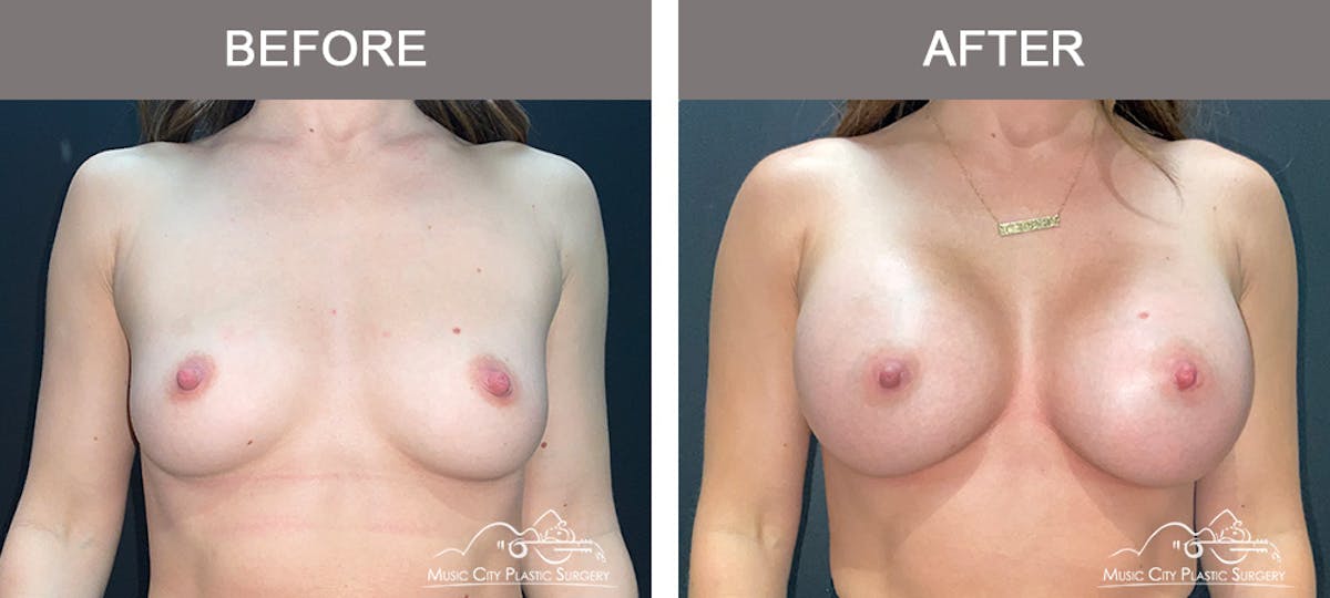 Breast Augmentation Before & After Gallery - Patient 279070 - Image 1
