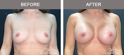 Breast Augmentation Before & After Gallery - Patient 279070 - Image 1
