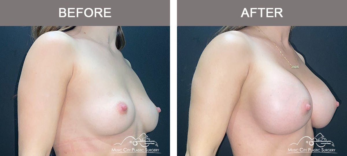 Breast Augmentation Before & After Gallery - Patient 279070 - Image 2