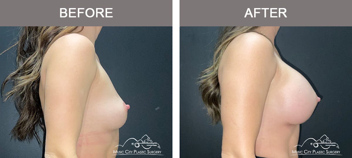 Breast Augmentation Before & After Gallery - Patient 279070 - Image 3