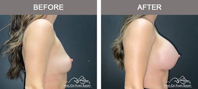 Breast Augmentation Before & After Gallery - Patient 279070 - Image 3