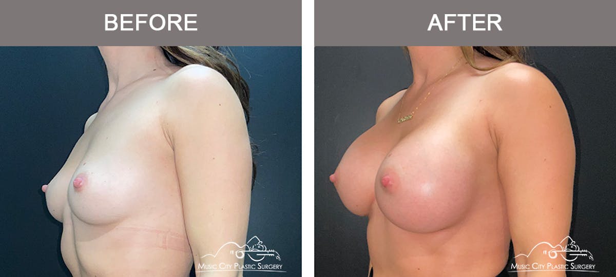 Breast Augmentation Before & After Gallery - Patient 279070 - Image 4