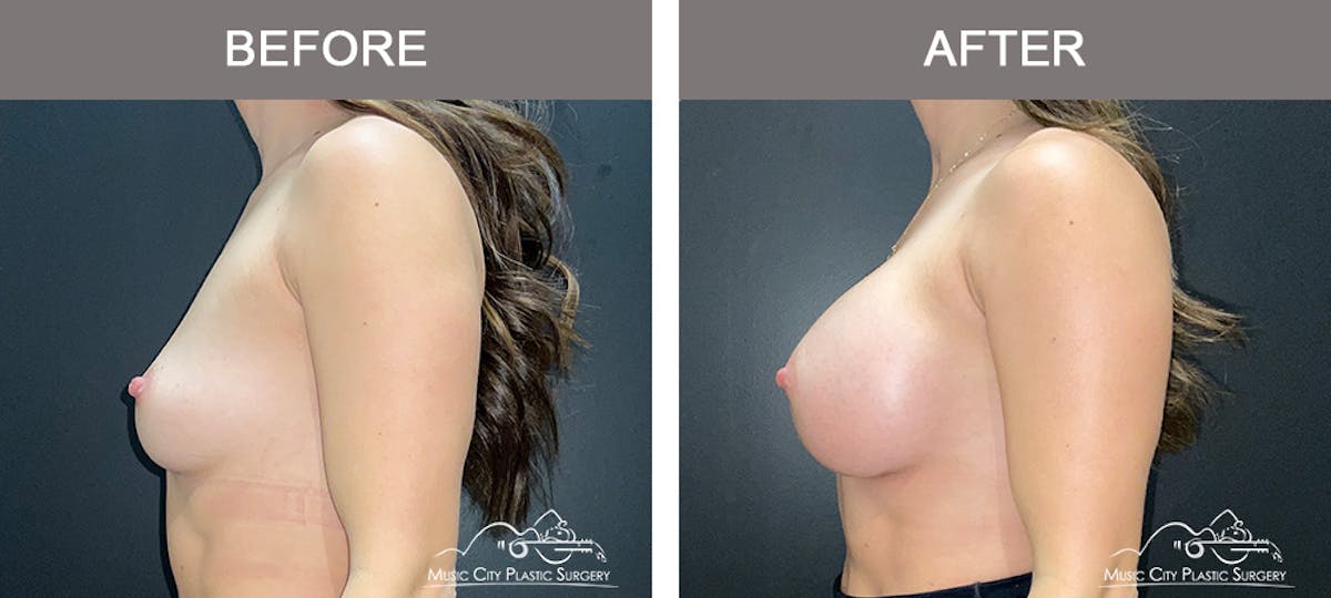 Breast Augmentation Before & After Gallery - Patient 279070 - Image 5