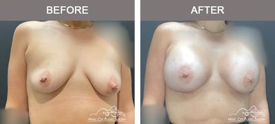 Breast Augmentation Before & After Gallery - Patient 261778 - Image 1