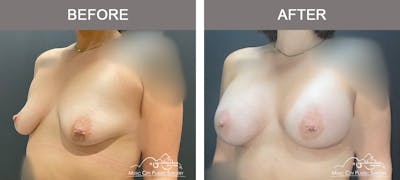 Breast Augmentation Before & After Gallery - Patient 261778 - Image 2