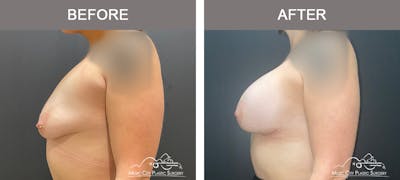 Breast Augmentation Before & After Gallery - Patient 261778 - Image 3