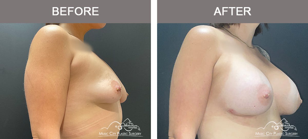 Breast Augmentation Before & After Gallery - Patient 261778 - Image 4