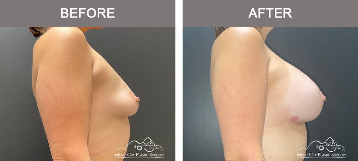 Breast Augmentation Before & After Gallery - Patient 261778 - Image 5