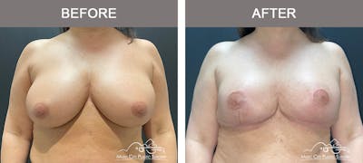 Breast Reduction Before & After Gallery - Patient 420285 - Image 1