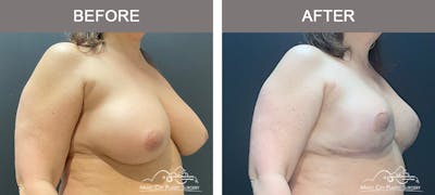Breast Reduction Before & After Gallery - Patient 420285 - Image 2