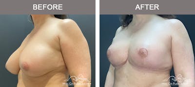 Breast Reduction Before & After Gallery - Patient 420285 - Image 3