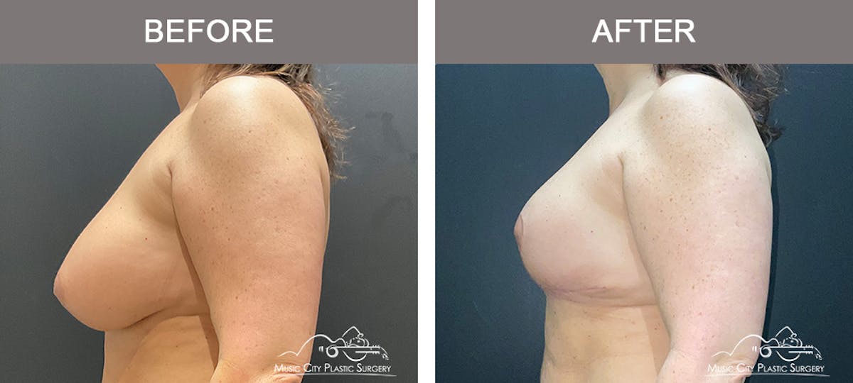 Breast Reduction Before & After Gallery - Patient 420285 - Image 4