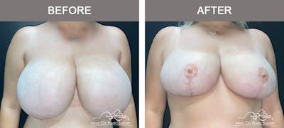 Breast Reduction Before & After Gallery - Patient 183101 - Image 1