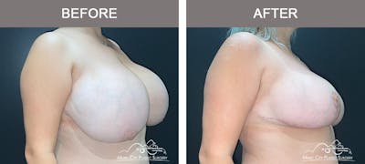 Breast Reduction Before & After Gallery - Patient 183101 - Image 2