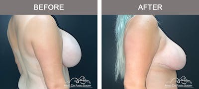 Breast Reduction Before & After Gallery - Patient 183101 - Image 3