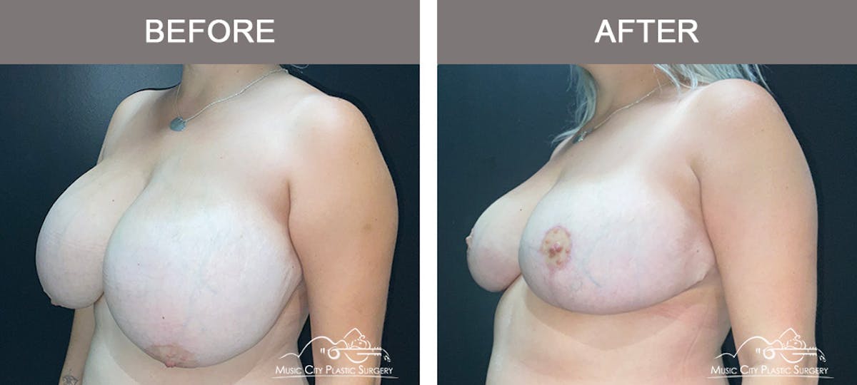 Breast Reduction Before & After Gallery - Patient 183101 - Image 4