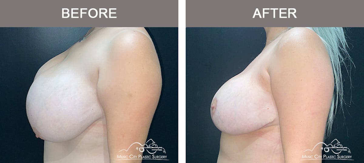 Breast Reduction Before & After Gallery - Patient 183101 - Image 5