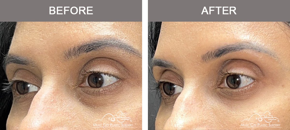 Dermal Fillers Before & After Gallery - Patient 250499 - Image 1