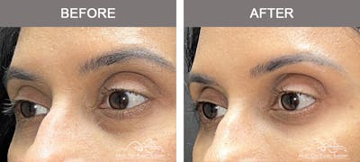 Dermal Fillers Before & After Gallery - Patient 250499 - Image 1